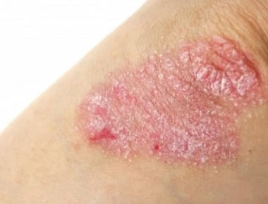 Ψωρίαση: Είναι μεταδοτική; Τι πρέπει να τρώω για να μην έχω εξάρσεις;